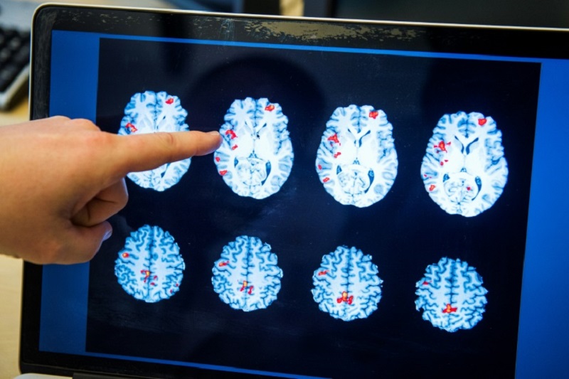 ضربه مغزی احتمال ابتلا به آلزایمر را افزایش می دهد
