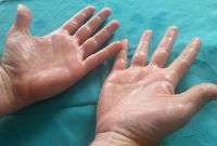 درمان عرق کف دست؛ علت عرق کردن کف دست چیست؟